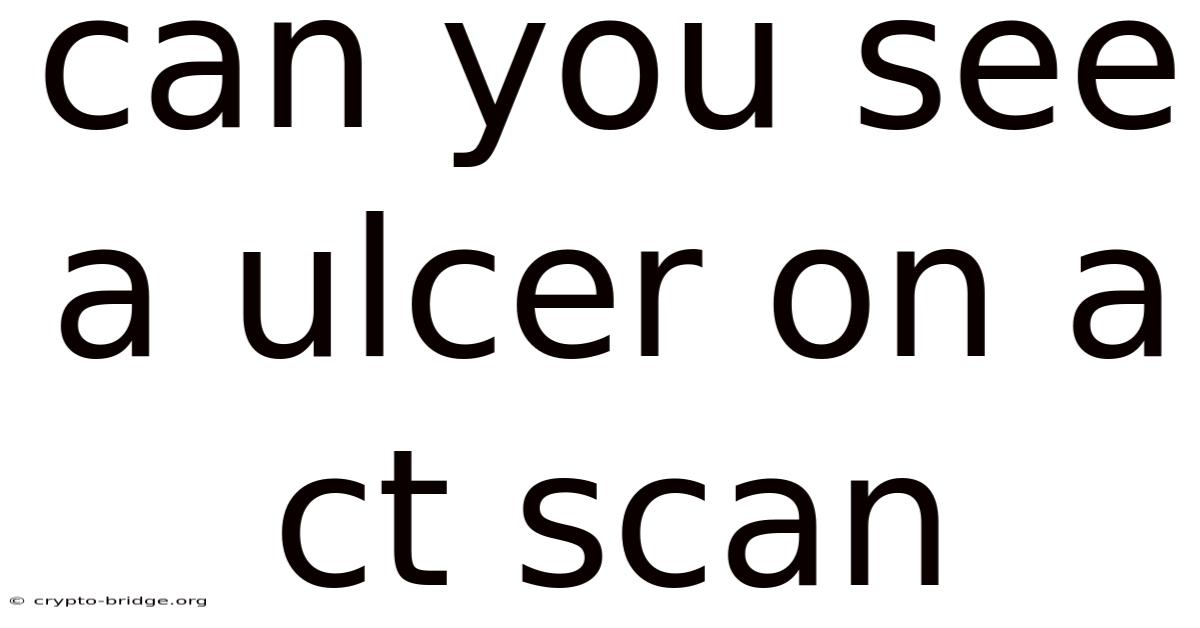 Can You See A Ulcer On A Ct Scan