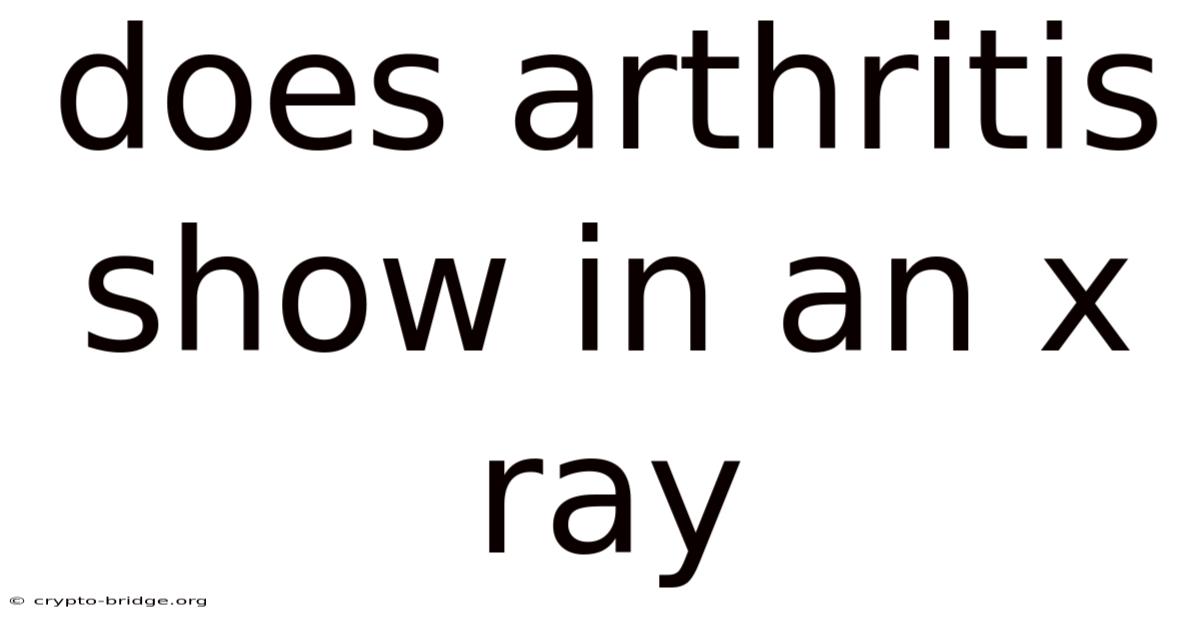Does Arthritis Show In An X Ray