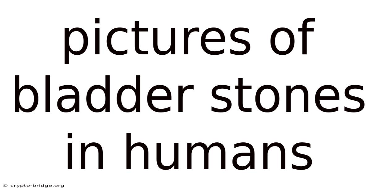 Pictures Of Bladder Stones In Humans